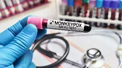 Monkeypox Menace| ಎಂಪಾಕ್ಸ್‌  ಮುಂದಿನ ಕೋವಿಡ್‌ ಆಗುವುದೇ?