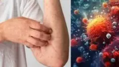 Mpox in Bangalore | ಬೆಂಗಳೂರಿನಲ್ಲಿ ಶಂಕಿತ ಮಂಕಿಪಾಕ್ಸ್ ಪ್ರಕರಣ