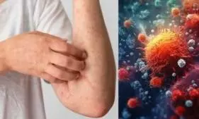 Mpox in Bangalore | ಬೆಂಗಳೂರಿನಲ್ಲಿ ಶಂಕಿತ ಮಂಕಿಪಾಕ್ಸ್ ಪ್ರಕರಣ