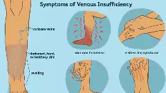 ಡೊನಾಲ್ಡ್ ಟ್ರಂಪ್‌ಗೆ ಕ್ರಾನಿಕ್ ವೀನಸ್ ಇನ್ಸಫಿಷಿಯನ್ಸಿ ಕಾಯಿಲೆ? ಏನಿದು, ಇದರ ಲಕ್ಷಣಗಳೇನು?