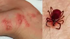 Scrub Typhus Scare in Andhra Pradesh: First Death Reported, Over 1,300 Cases Detected; Karnataka Border on Alert