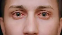 Increased Madras Eye threat in Karnataka: Health Department on high alert