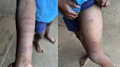 ಶಿವಮೊಗ್ಗ ಜಿಲ್ಲೆಯಲ್ಲಿ ಶಿಕ್ಷಕರೊಬ್ಬರ ಕ್ರೌರ್ಯ: ವಿದ್ಯಾರ್ಥಿಯ ಮೈಮೇಲೆ 22 ಬಾಸುಂಡೆ..!