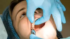 Dental Bhagya | Root canal treatment no longer requires a lot of money, just an Ayushman card!